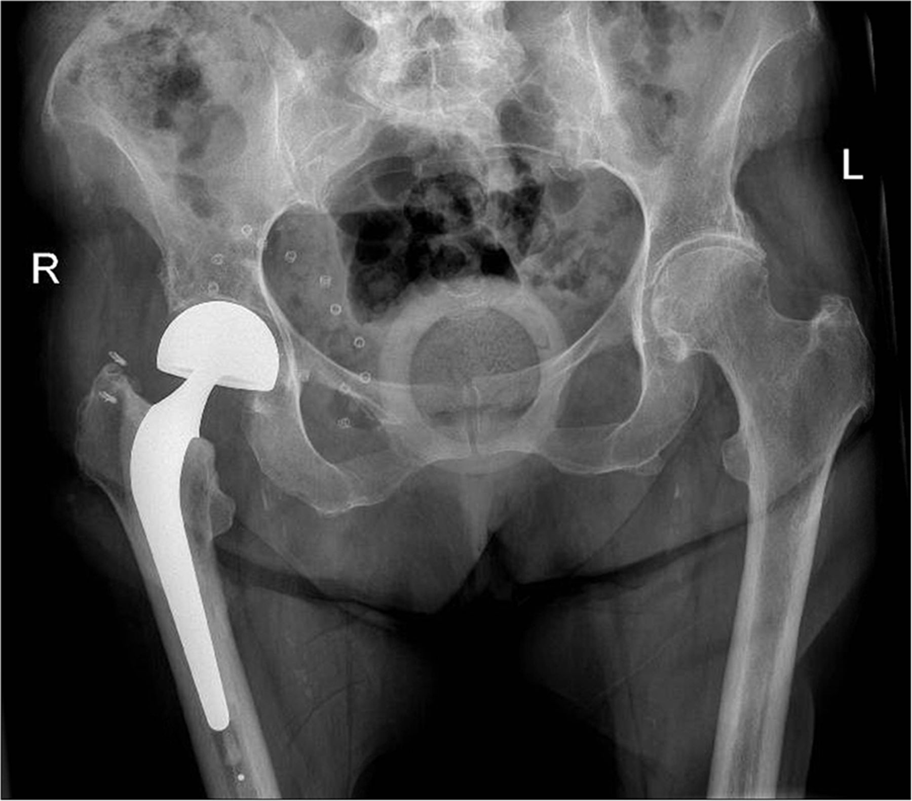 Hemi replacement of the hip