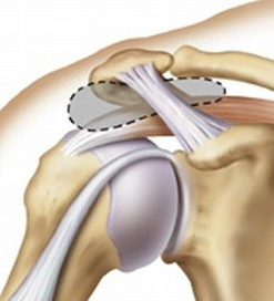 Subacromial decompression surgery