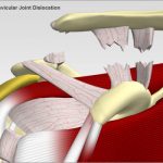 Acromioclavicular Joint Dislocation