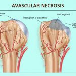 Avascular Necrosis Of The Shoulder