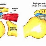Shoulder Impingement Syndrome