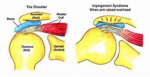 Shoulder Impingement Syndrome
