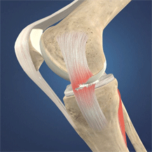 Knee Ligament conditions