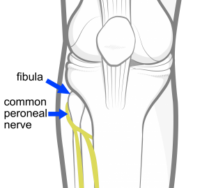 Peroneal nerve knee injury