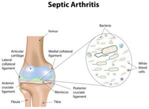 septic arthritis of the knee