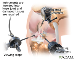 Arthroscopy Knee Procedure