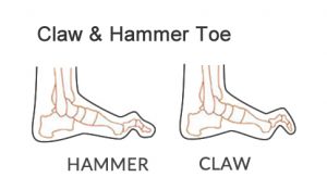 Claw Toe and Hammer Toe