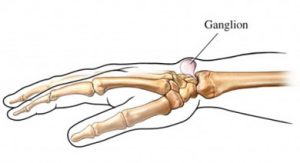 Ganglion cyst of the Wrist