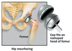 Hip Resurfacing Procedure