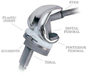 Read more about the article Knee Replacement Prosthetics