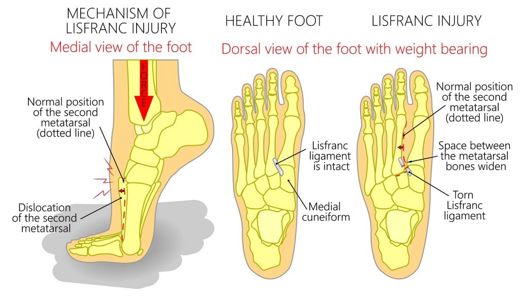 Ankle & Foot Archives | Joint Clinic Paarl