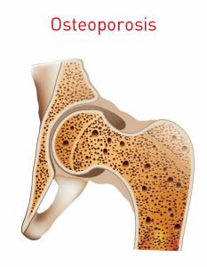 Osteoporosis of the Hip