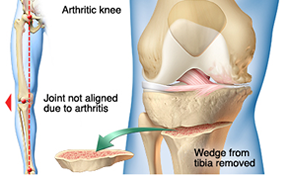 Osteotomies Knee Procedure