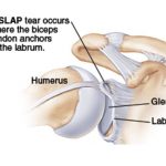 SLAP Lesion Tear