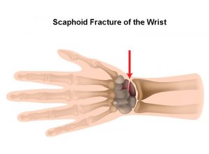 Scaphoid Fracture of the Wrist