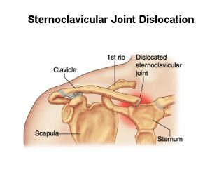 Sternoclavicular Joint Dislocation