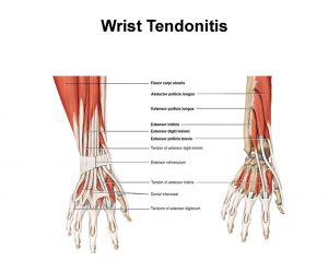 Wrist-tendonitis