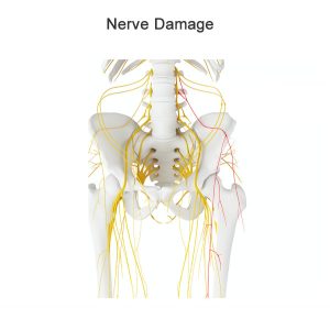 Nerve Injuries around the Hip