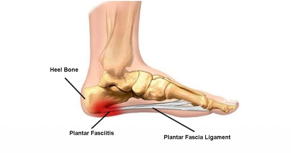 Plantar Fasciitis