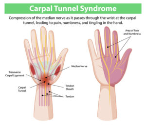Carpal tunnel syndrome