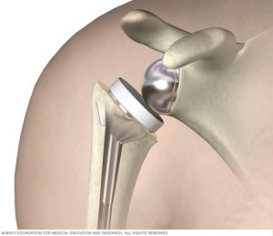 Read more about the article Shoulder Prosthesis