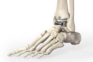 Read more about the article Ankle prosthesis