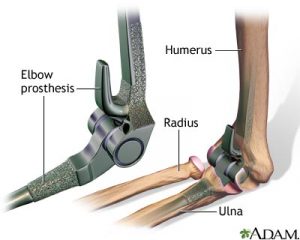 Read more about the article Elbow Prosthesis