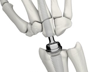Read more about the article Wrist prosthesis