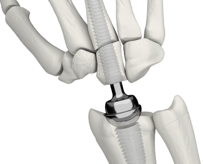 Wrist prosthesis