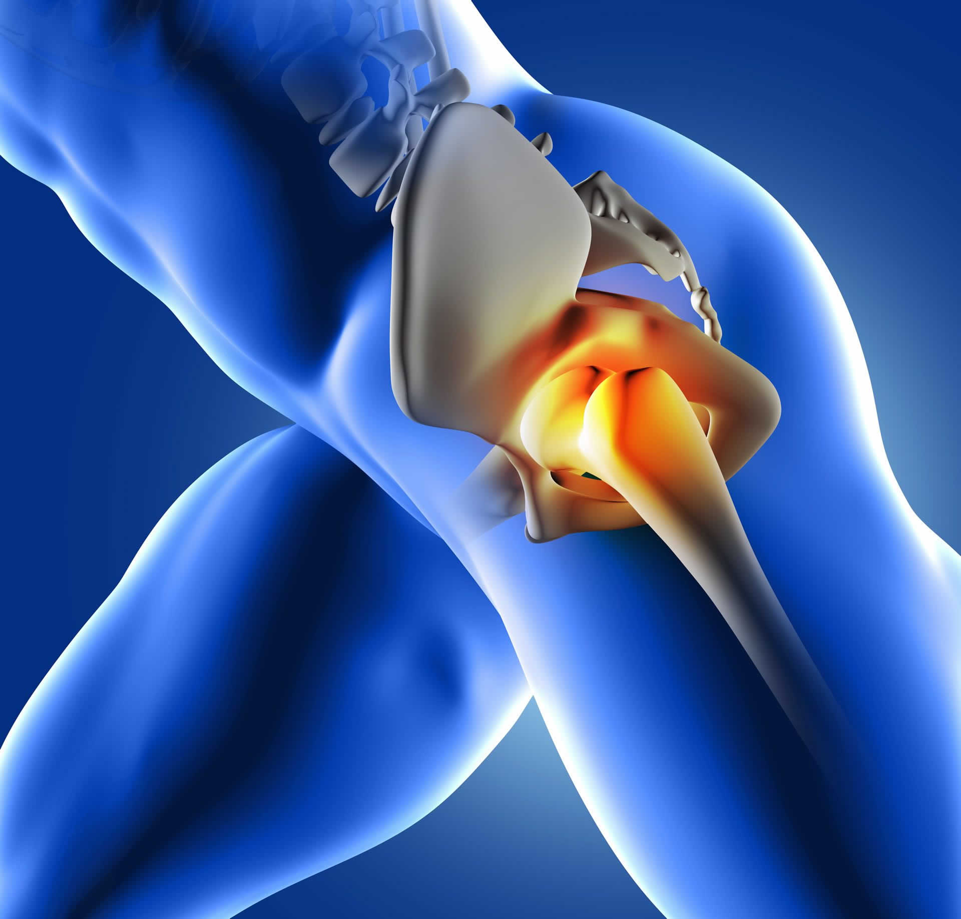 Complications of Hip Revision | Joint Clinic Paarl