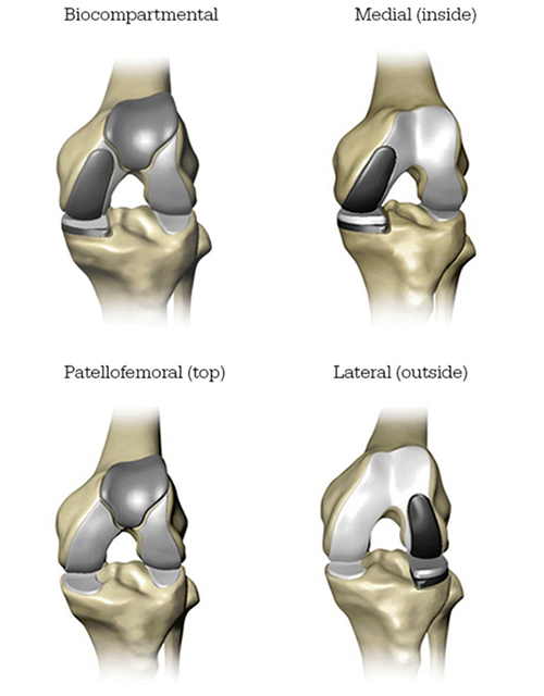 Selective Compartment Knee Replacement 2