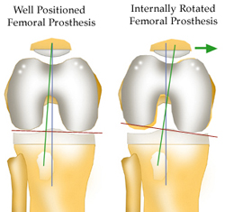 Femoral Implant Rotation