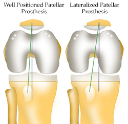 Patellar lateralization